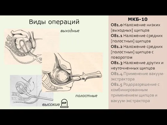 Виды операций МКБ-10 O81.0 Наложение низких [выходных] щипцов O81.1 Наложение