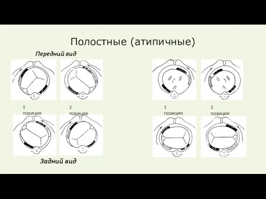 Полостные (атипичные) 1 позиция 2 позиция Передний вид Задний вид 1 позиция 2 позиция