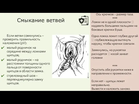 Если ветви сомкнулись – проверить правильность наложения (pV): малый родничок