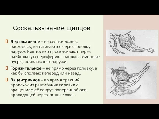 Соскальзывание щипцов Вертикальное – верхушки ложек, расходясь, вытягиваются через головку