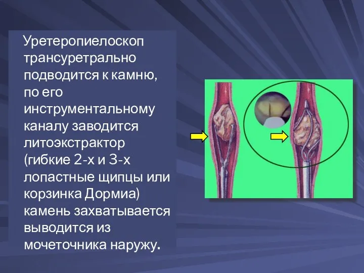 Уретеропиелоскоп трансуретрально подводится к камню, по его инструментальному каналу заводится литоэкстрактор (гибкие 2-х