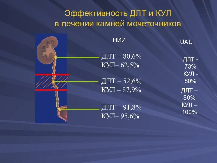 Эффективность ДЛТ и КУЛ в лечении камней мочеточников ДЛТ -