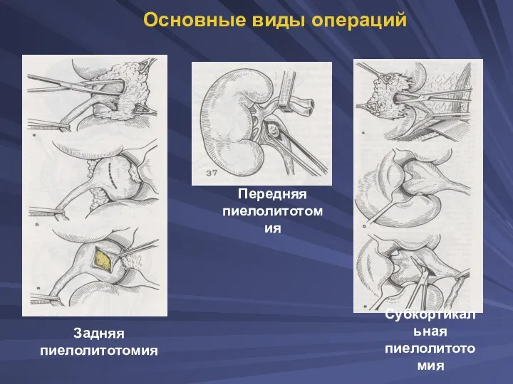 Субкортикальная пиелолитотомия Передняя пиелолитотомия Основные виды операций Задняя пиелолитотомия