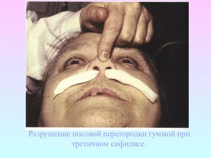 Разрушение носовой перегородки гуммой при третичном сифилисе.