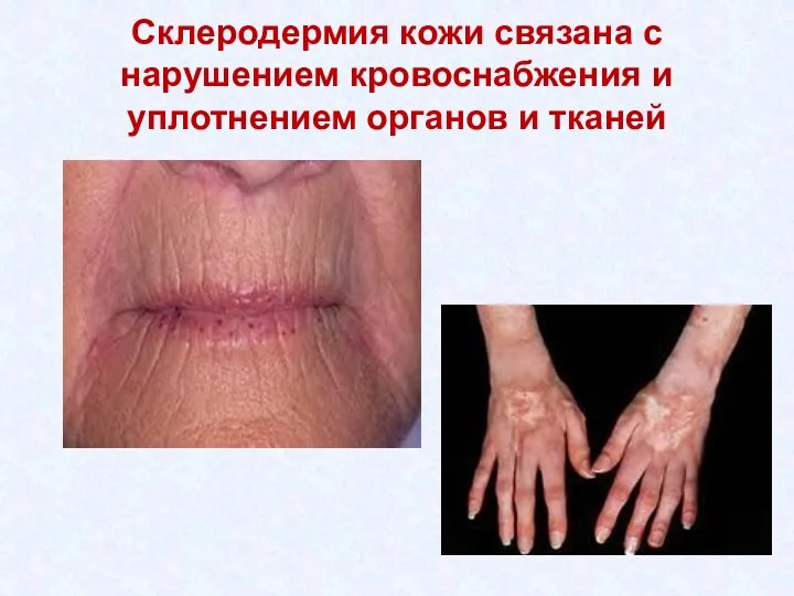Склеродермия кожи связана с нарушением кровоснабжения и уплотнением органов и тканей
