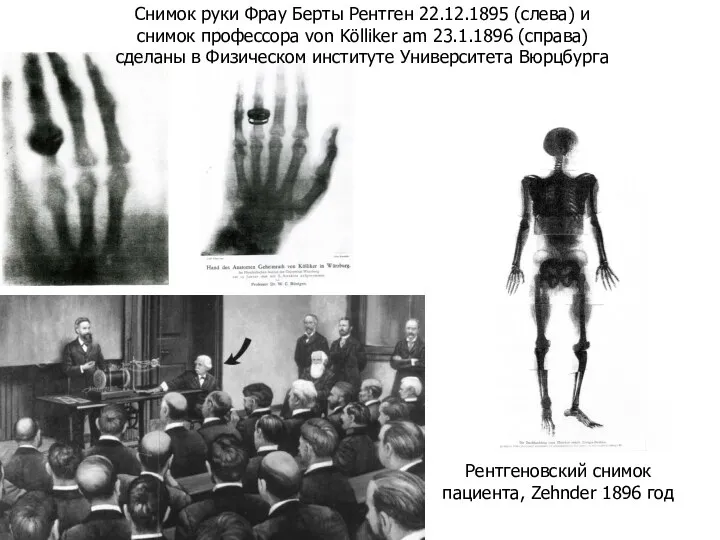 Рентгеновский снимок пациента, Zehnder 1896 год Снимок руки Фрау Берты