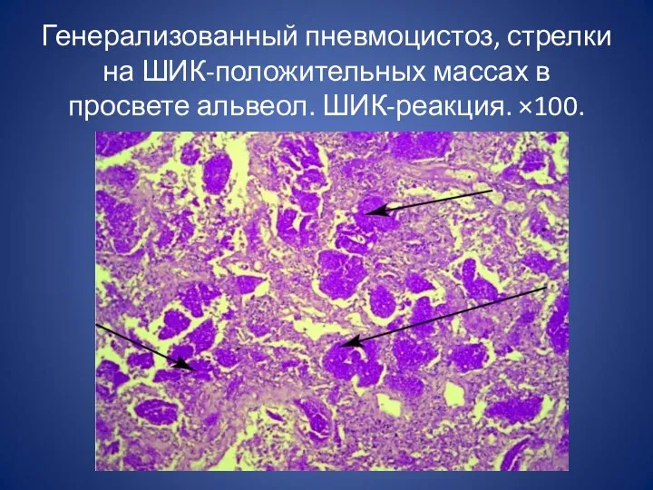 Генерализованный пневмоцистоз, стрелки на ШИК-положительных массах в просвете альвеол. ШИК-реакция. ×100.