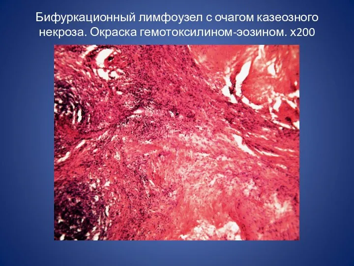 Бифуркационный лимфоузел с очагом казеозного некроза. Окраска гемотоксилином-эозином. х200