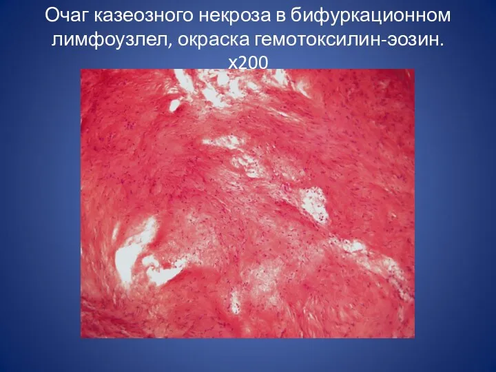 Очаг казеозного некроза в бифуркационном лимфоузлел, окраска гемотоксилин-эозин. х200