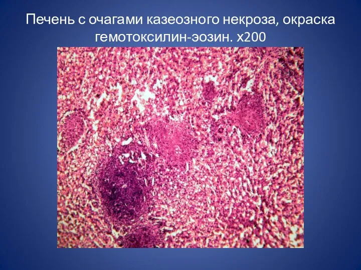 Печень с очагами казеозного некроза, окраска гемотоксилин-эозин. х200