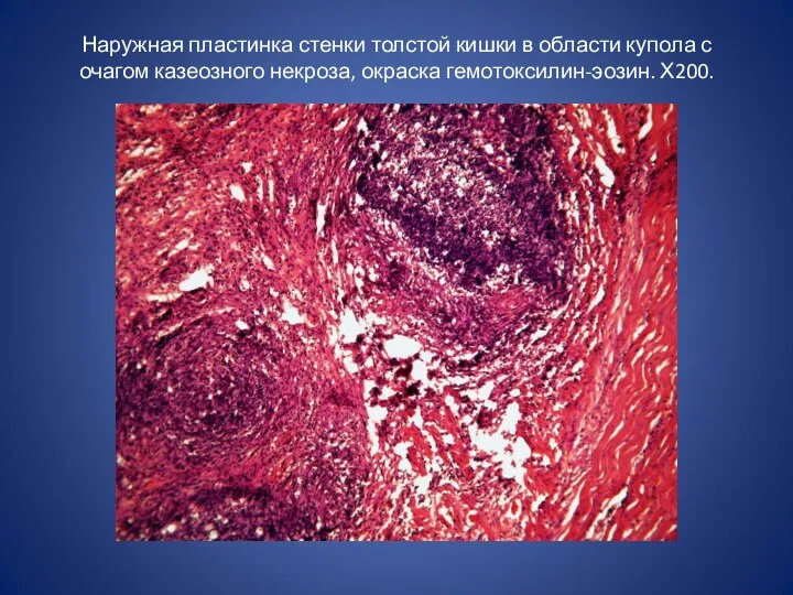 Наружная пластинка стенки толстой кишки в области купола с очагом казеозного некроза, окраска гемотоксилин-эозин. Х200.