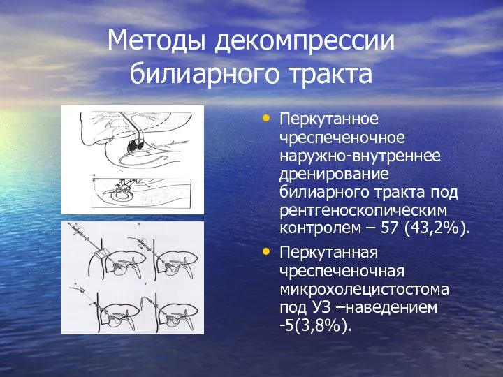 Методы декомпрессии билиарного тракта Перкутанное чреспеченочное наружно-внутреннее дренирование билиарного тракта под рентгеноскопическим контролем