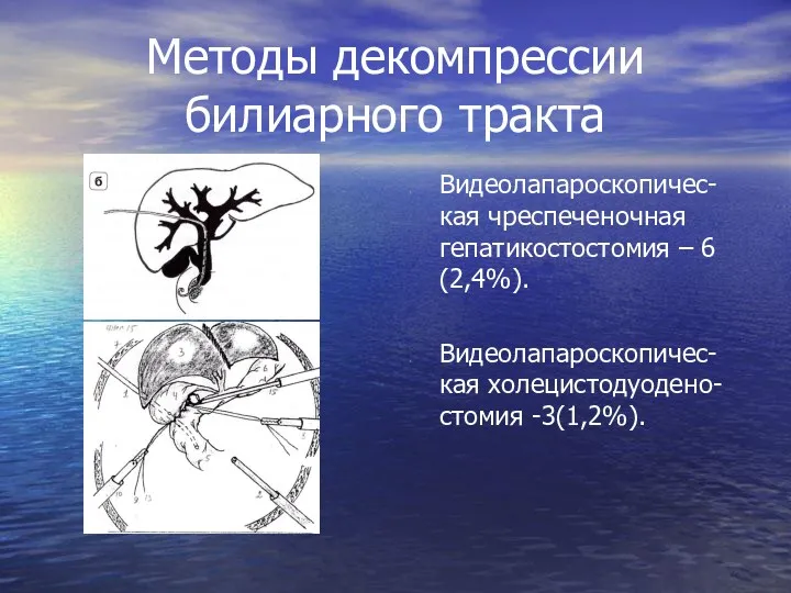 Методы декомпрессии билиарного тракта Видеолапароскопичес-кая чреспеченочная гепатикостостомия – 6 (2,4%). Видеолапароскопичес-кая холецистодуодено-стомия -3(1,2%).