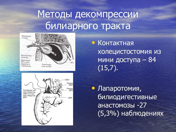 Методы декомпрессии билиарного тракта Контактная холецистостомия из мини доступа –