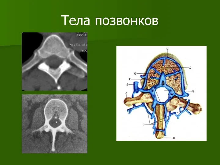 Тела позвонков