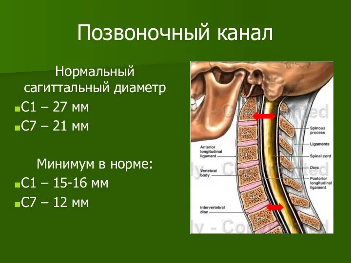 Позвоночный канал Нормальный сагиттальный диаметр С1 – 27 мм С7