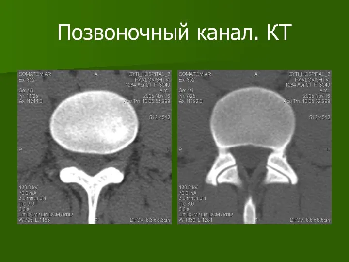 Позвоночный канал. КТ