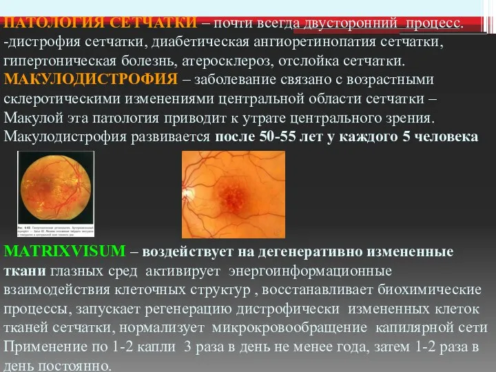 ПАТОЛОГИЯ СЕТЧАТКИ – почти всегда двусторонний процесс. -дистрофия сетчатки, диабетическая