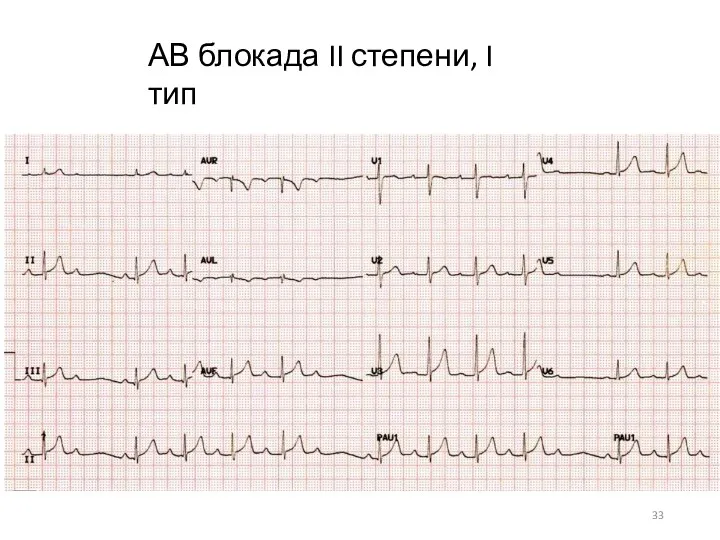 АВ блокада II степени, I тип