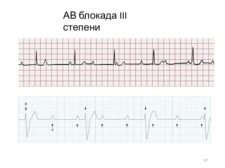 АВ блокада III степени