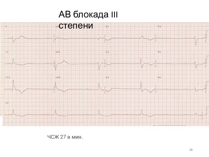 ЧСЖ 27 в мин. АВ блокада III степени