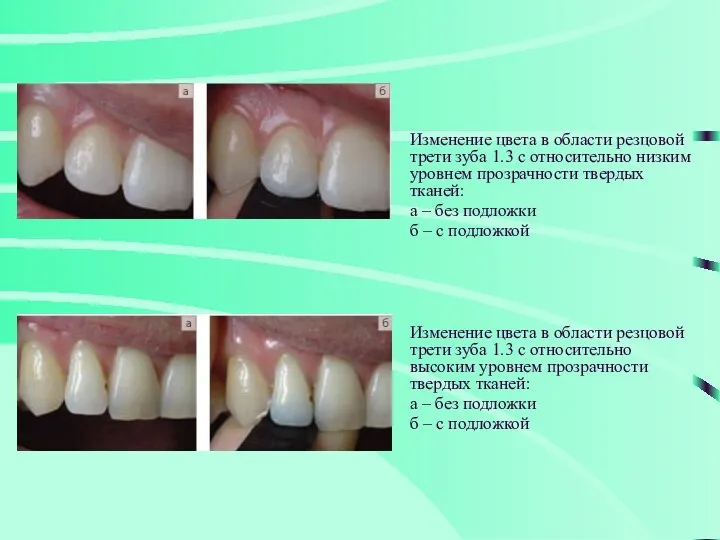 Изменение цвета в области резцовой трети зуба 1.3 с относительно
