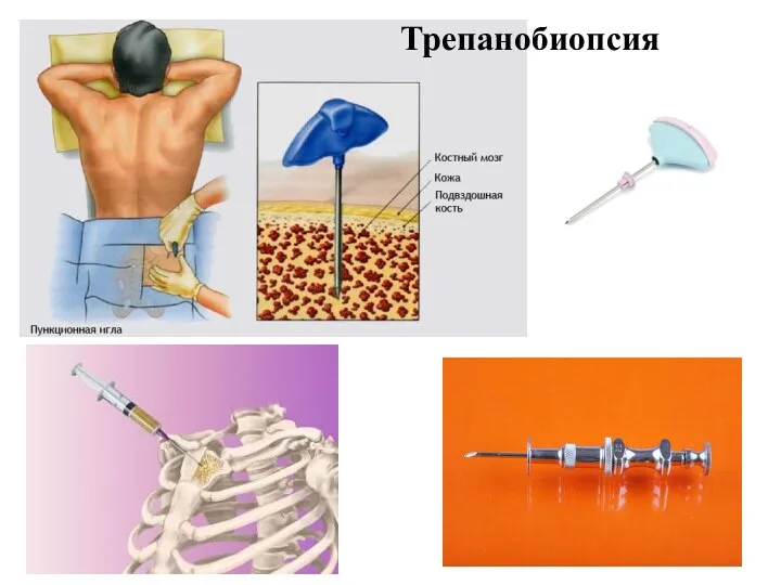 Трепанобиопсия