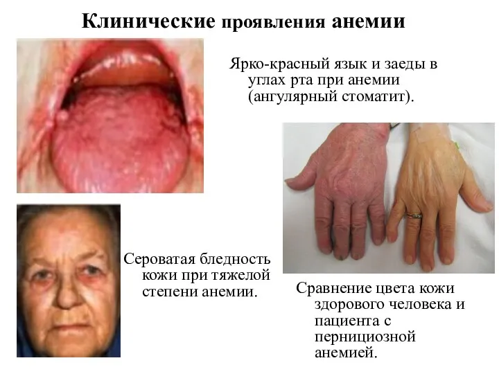 Клинические проявления анемии Сравнение цвета кожи здорового человека и пациента