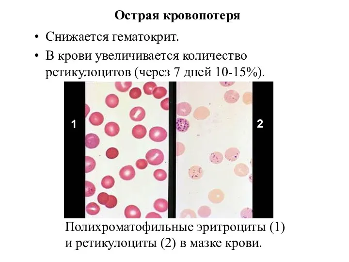 Острая кровопотеря Снижается гематокрит. В крови увеличивается количество ретикулоцитов (через