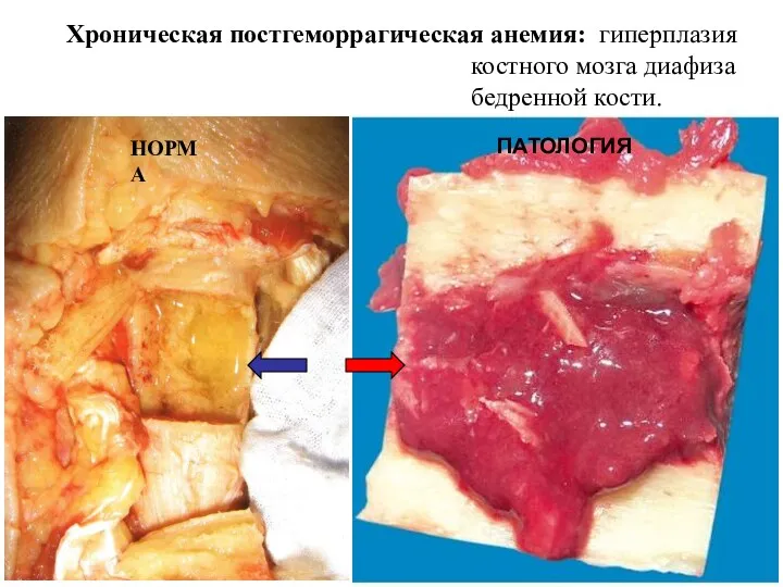 Хроническая постгеморрагическая анемия: гиперплазия костного мозга диафиза бедренной кости.