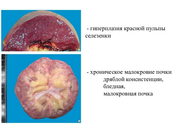 - гиперплазия красной пульпы селезенки - хроническое малокровие почки дряблой консистенции, бледная, малокровная почка