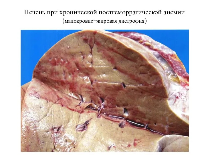 Печень при хронической постгеморрагической анемии (малокровие+жировая дистрофия)