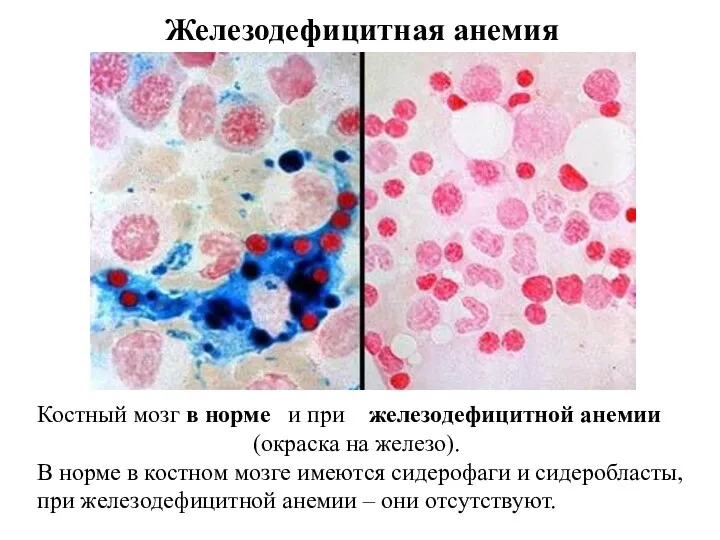 Костный мозг в норме и при железодефицитной анемии (окраска на