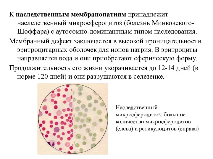 К наследственным мембранопатиям принадлежит наследственный микросфероцитоз (болезнь Минковского-Шоффара) с аутосомно-доминантным