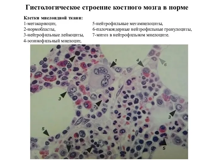 Гистологическое строение костного мозга в норме Клетки миелоидной ткани: 1-мегакариоцит,