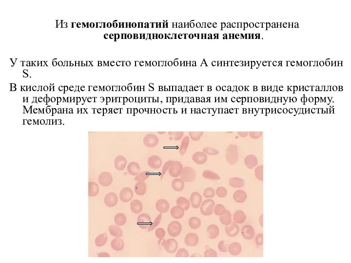 Из гемоглобинопатий наиболее распространена серповидноклеточная анемия. У таких больных вместо