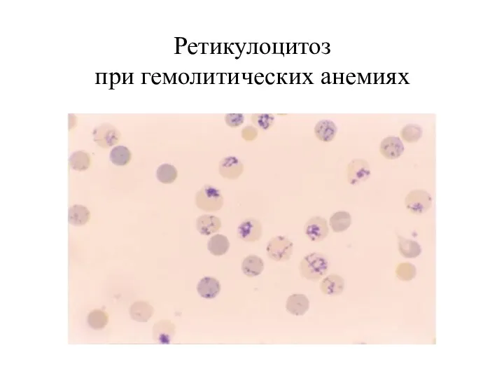 Ретикулоцитоз при гемолитических анемиях
