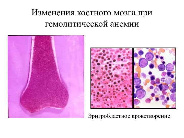 Изменения костного мозга при гемолитической анемии Эритробластное кроветворение