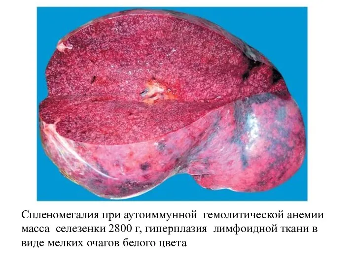 Спленомегалия при аутоиммунной гемолитической анемии масса селезенки 2800 г, гиперплазия