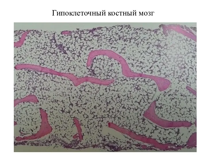 Гипоклеточный костный мозг