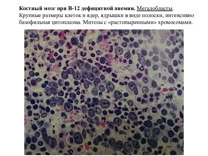 Костный мозг при В-12 дефицитной анемии. Мегалобласты. Крупные размеры клеток