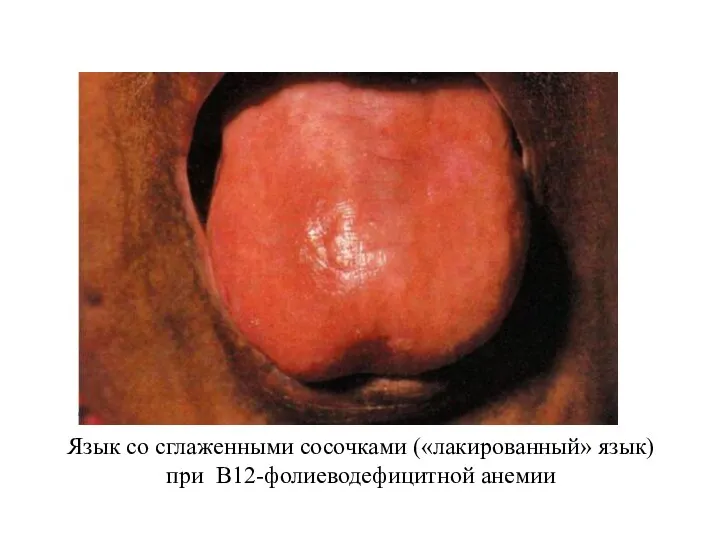Язык со сглаженными сосочками («лакированный» язык) при В12-фолиеводефицитной анемии