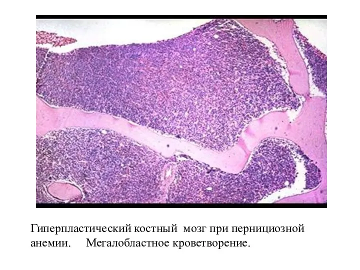 Гиперпластический костный мозг при пернициозной анемии. Мегалобластное кроветворение.