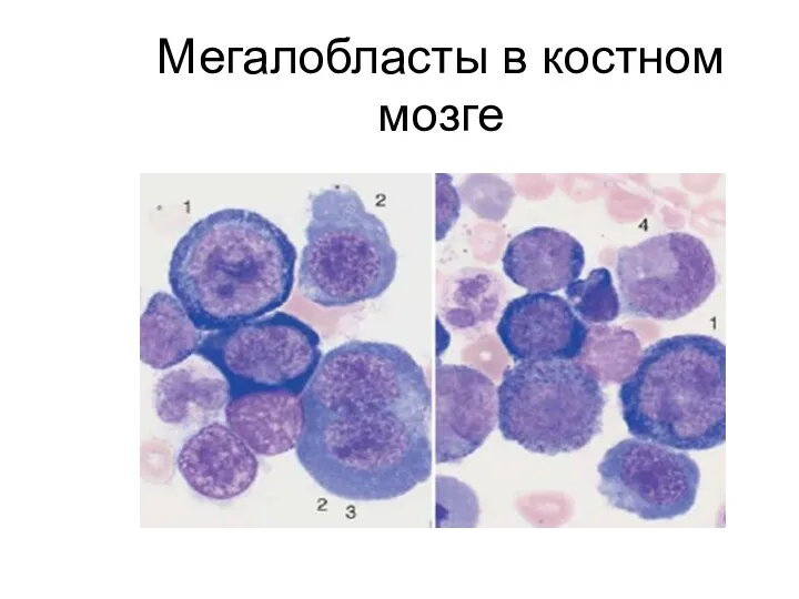 Мегалобласты в костном мозге