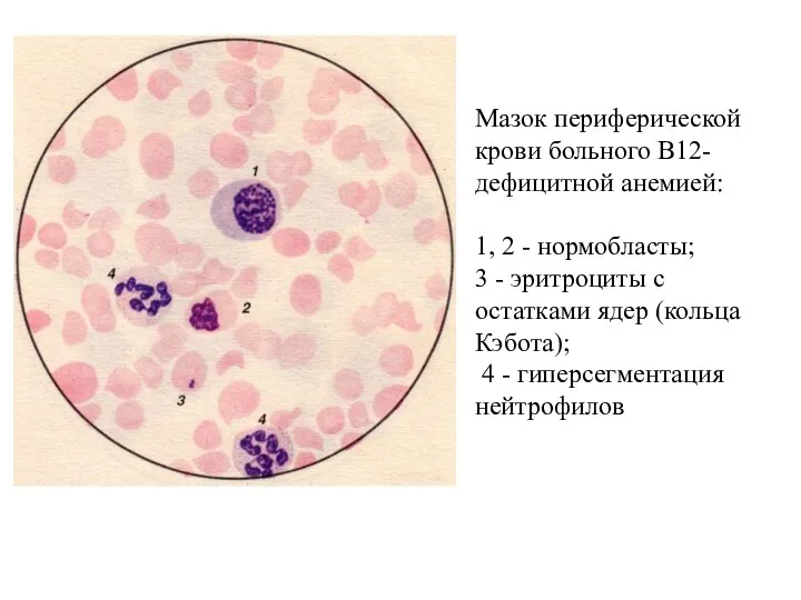 Мазок периферической крови больного В12-дефицитной анемией: 1, 2 - нормобласты;