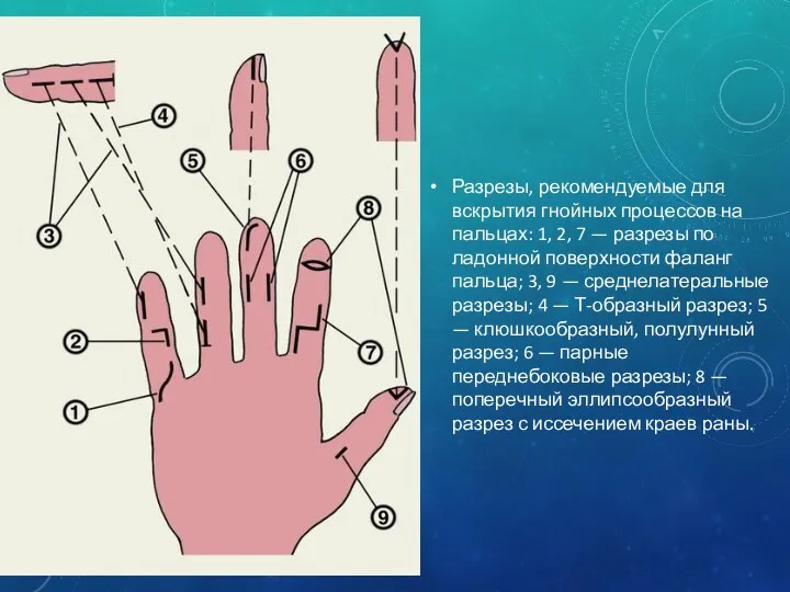 Разрезы, рекомендуемые для вскрытия гнойных процессов на пальцах: 1, 2,