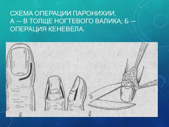 СХЕМА ОПЕРАЦИИ ПАРОНИХИИ. А — В ТОЛЩЕ НОГТЕВОГО ВАЛИКА; Б — ОПЕРАЦИЯ КЕНЕВЕЛА.