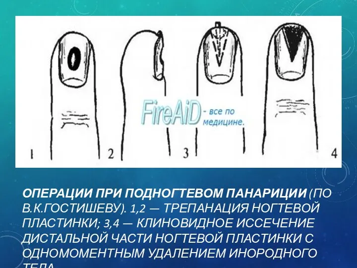 ОПЕРАЦИИ ПРИ ПОДНОГТЕВОМ ПАНАРИЦИИ (ПО В.К.ГОСТИШЕВУ). 1,2 — ТРЕПАНАЦИЯ НОГТЕВОЙ