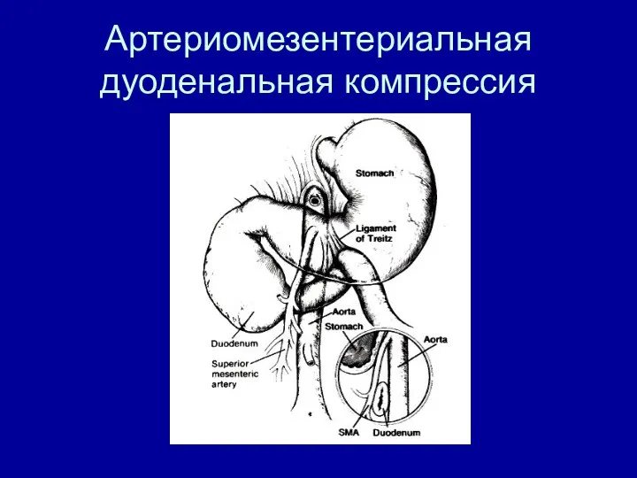 Артериомезентериальная дуоденальная компрессия