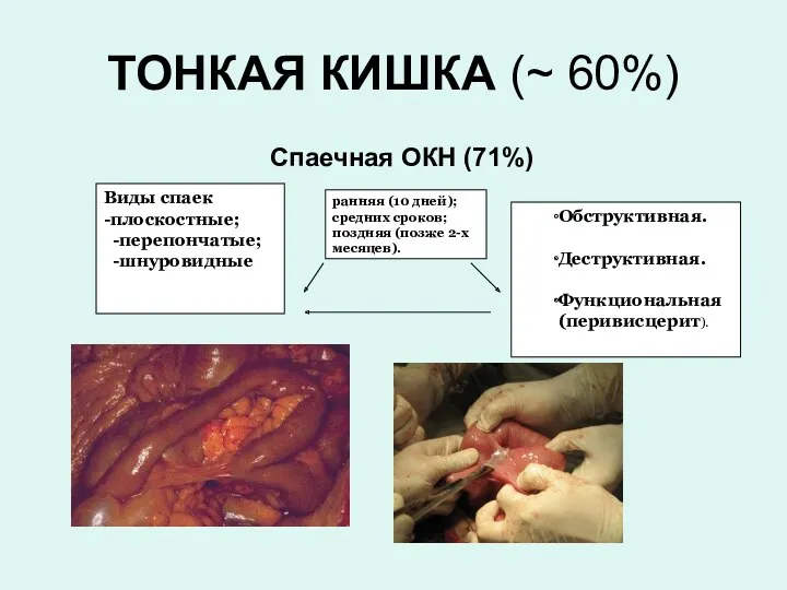 ТОНКАЯ КИШКА (~ 60%) Спаечная ОКН (71%) Виды спаек -плоскостные; перепончатые; шнуровидные ранняя